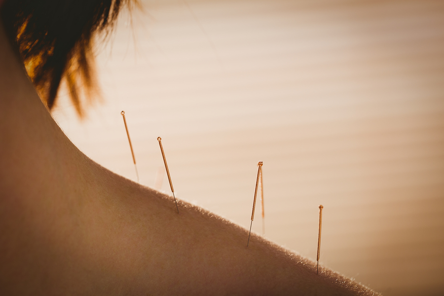 acupuncture for athletes